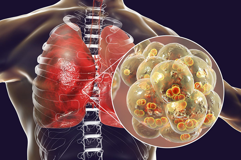 Viêm phổi: Phân loại bệnh và các biến chứng nguy hiểm | 7 biến chứng nguy hiểm của bệnh sốt xuất huyết